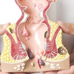 Hậu Môn Bình Thường Và Hậu Môn Bị Trĩ