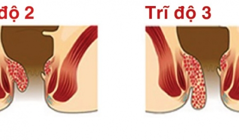 TRIỆU CHỨNG & CÁCH ĐIỀU TRỊ BỆNH TRĨ