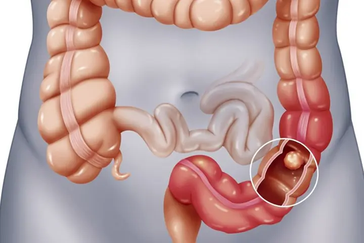 C&aacute;ch ph&ograve;ng ngừa bệnh vi&ecirc;m đại tr&agrave;ng