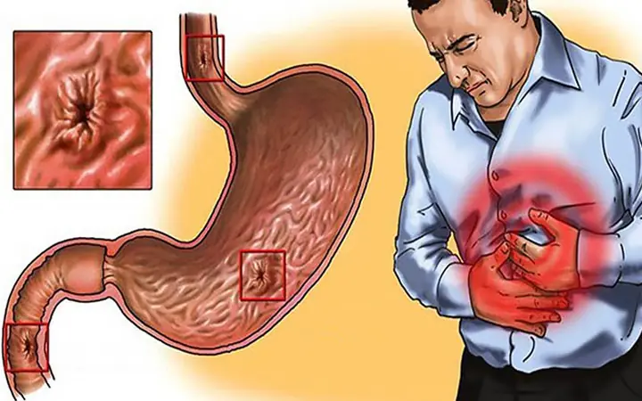 Nguy&ecirc;n nh&acirc;n g&acirc;y n&ecirc;n vi&ecirc;m dạ d&agrave;y cấp