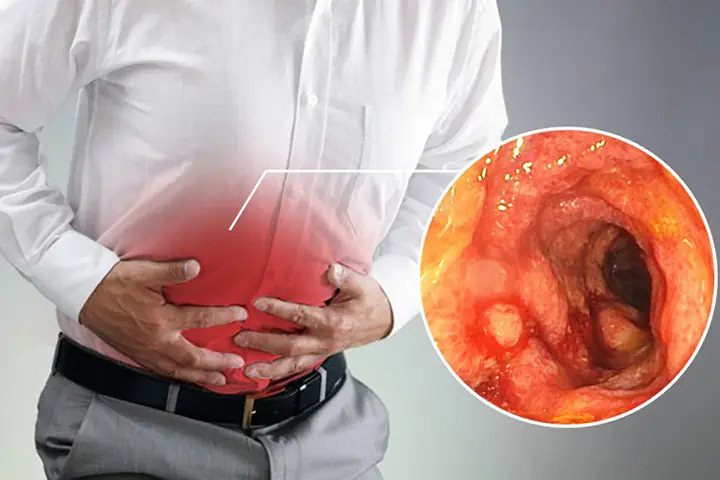 C&aacute;c triệu chứng bệnh vi&ecirc;m đại tr&agrave;ng